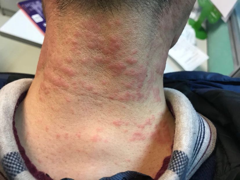1、膏藥過敏怎么辦？