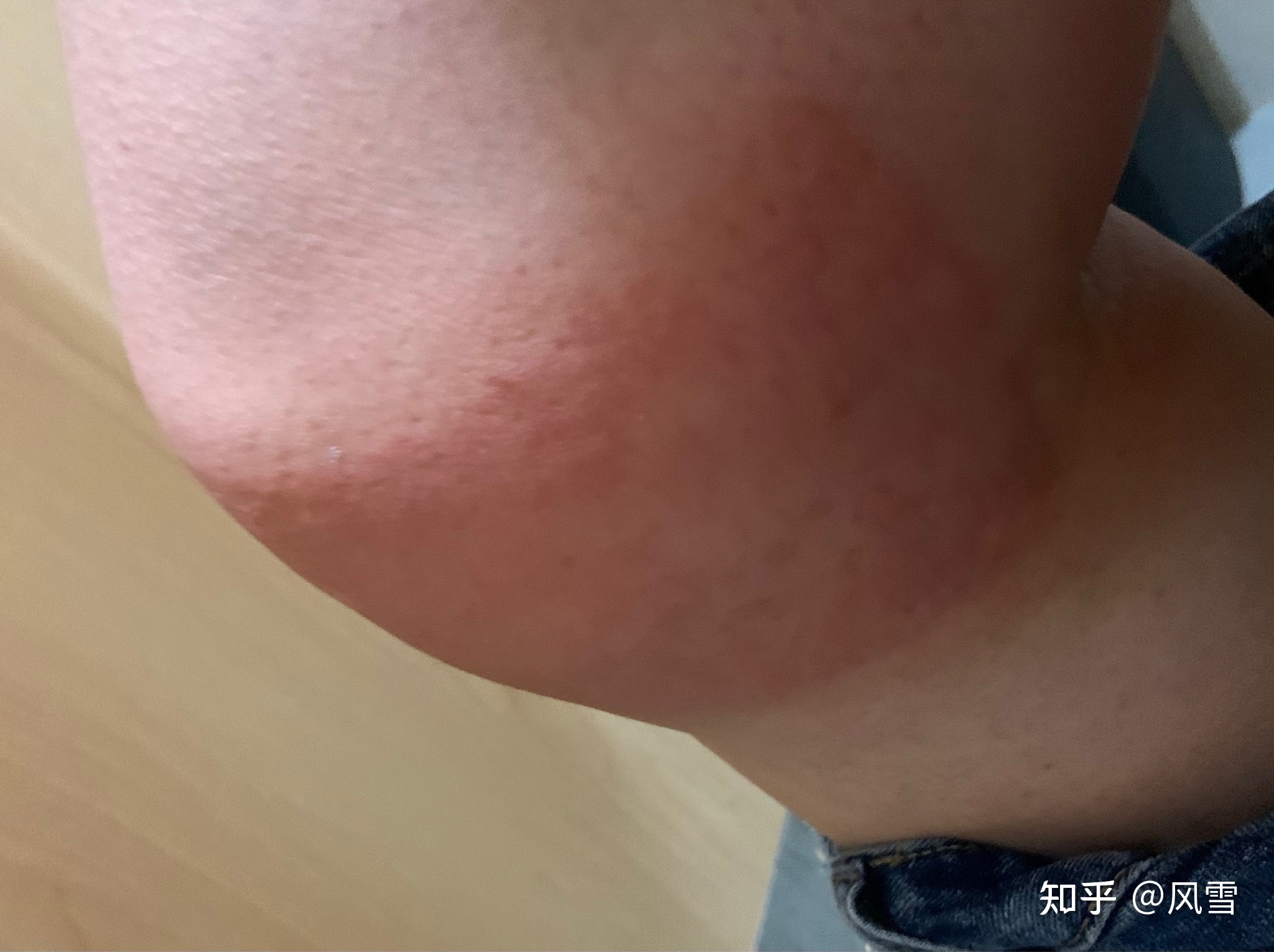 1、貼膏藥過(guò)敏癢紅腫怎么辦？