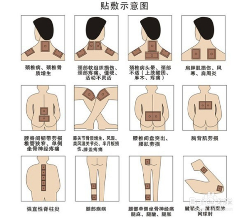 1、肩痛買什么膏藥可以貼？